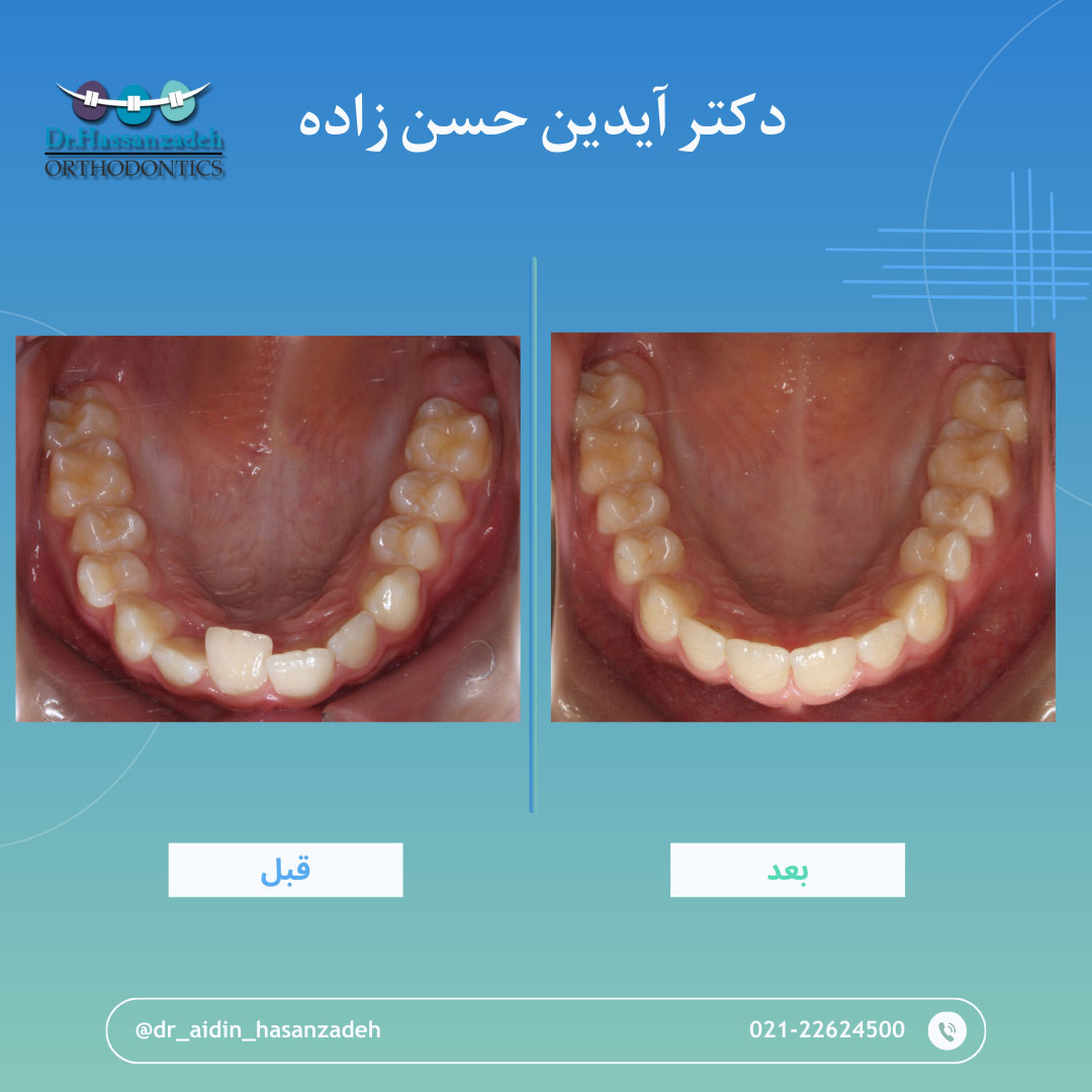 قبل و بعد از درمان اورتودنسی