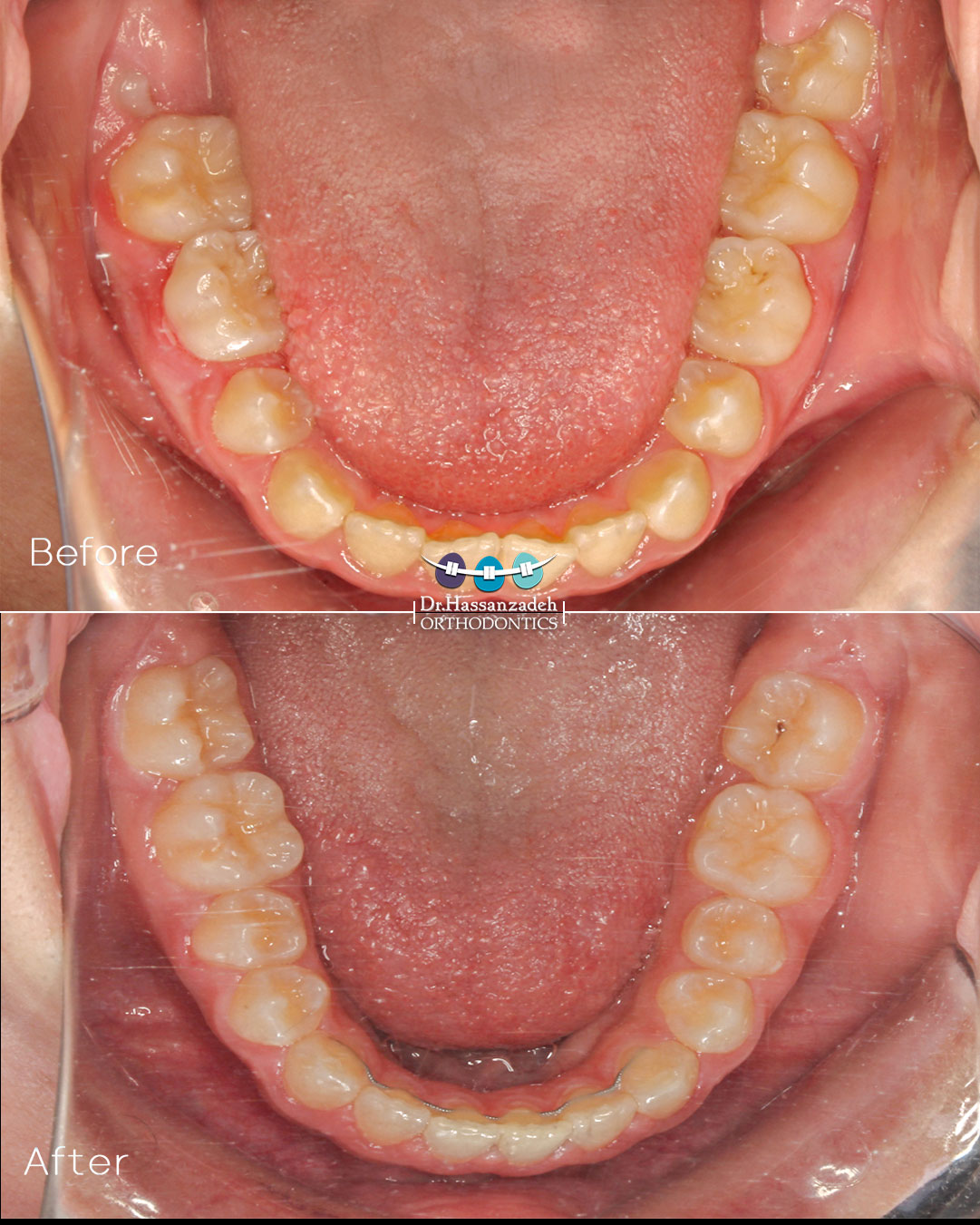 قبل و بعد از درمان اورتودنسی