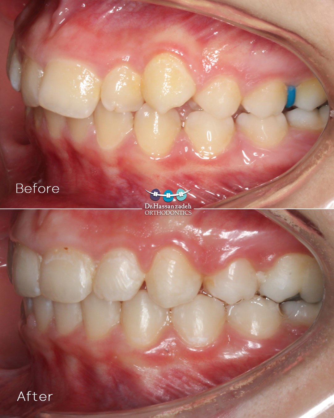 قبل و بعد از درمان اورتودنسی