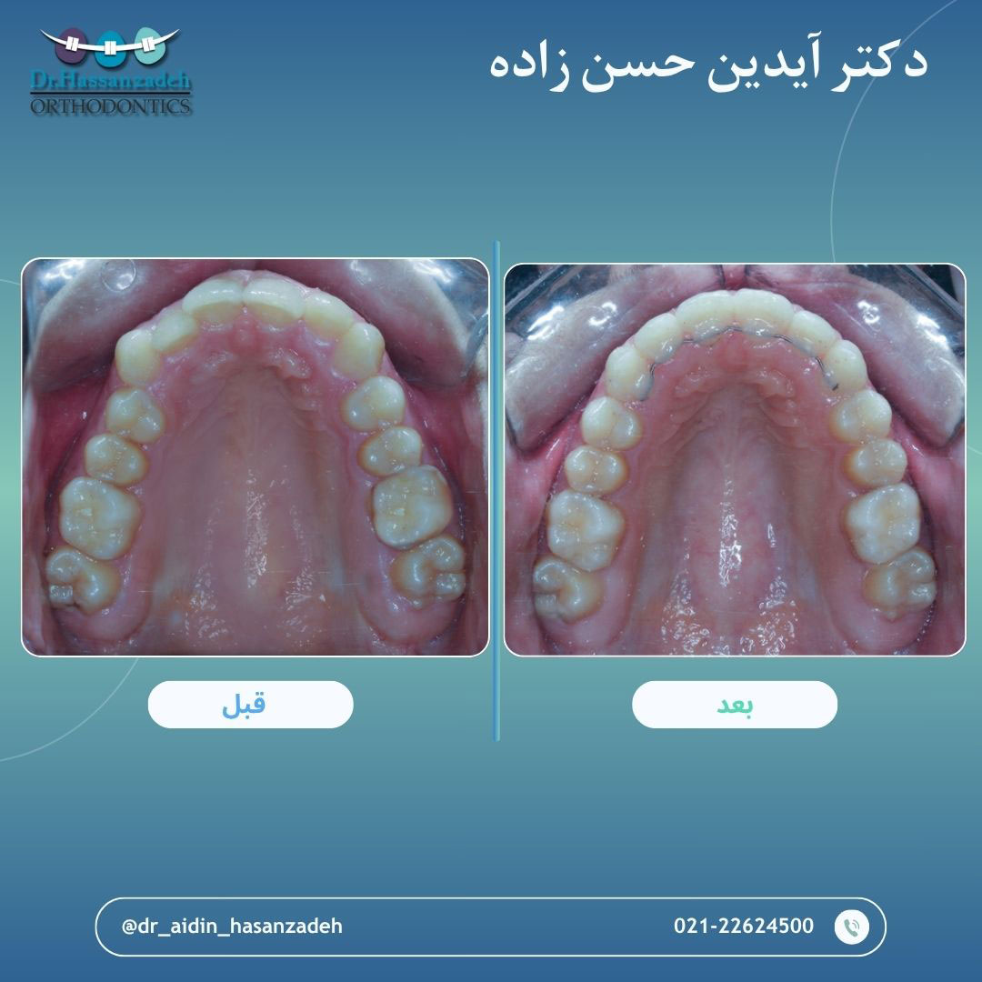 قبل و بعد از درمان اورتودنسی