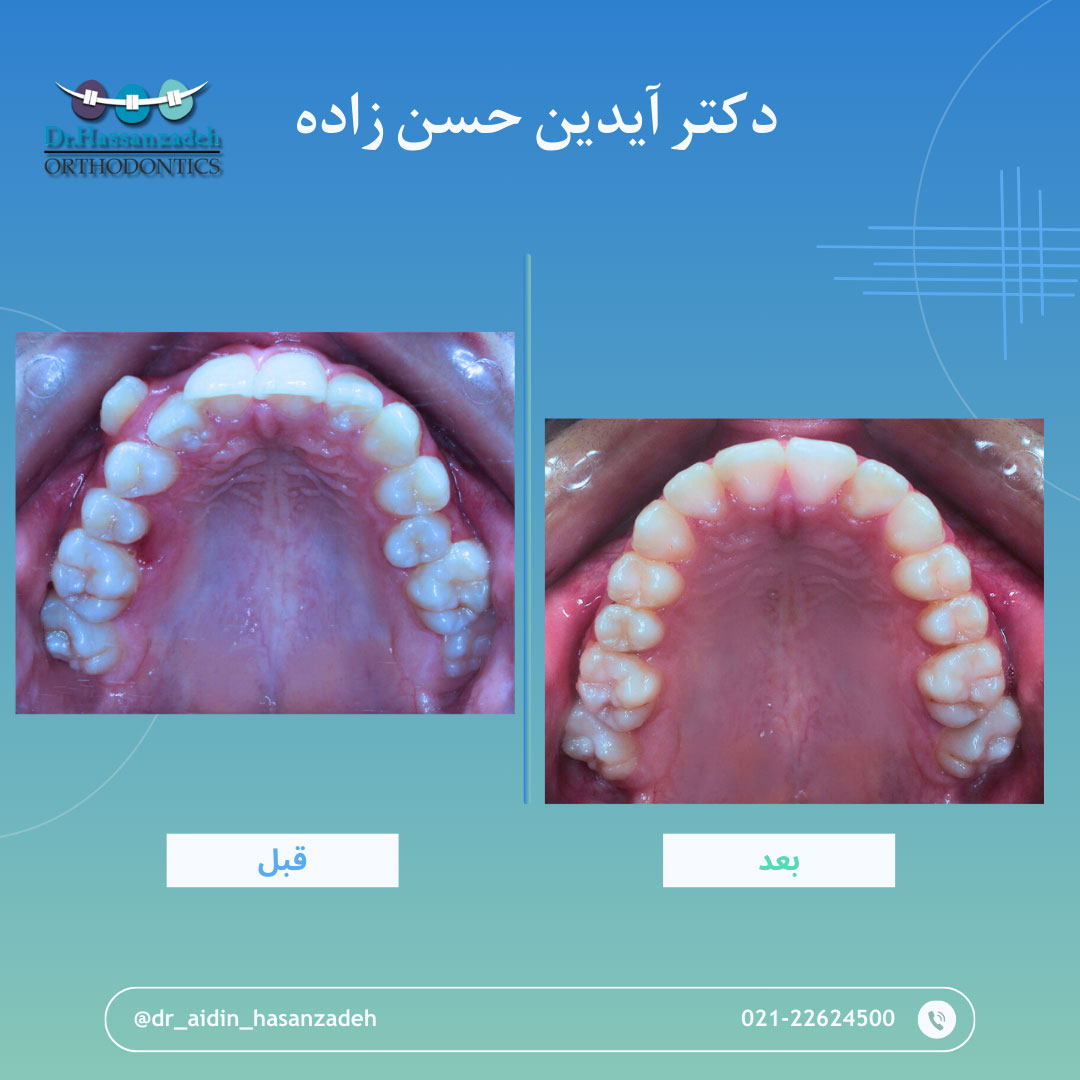 قبل و بعد از درمان اورتودنسی