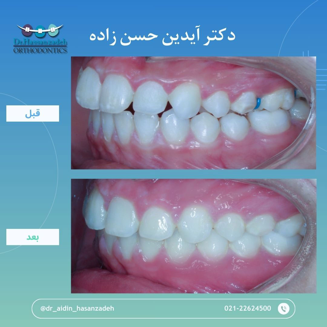 قبل و بعد از درمان اورتودنسی