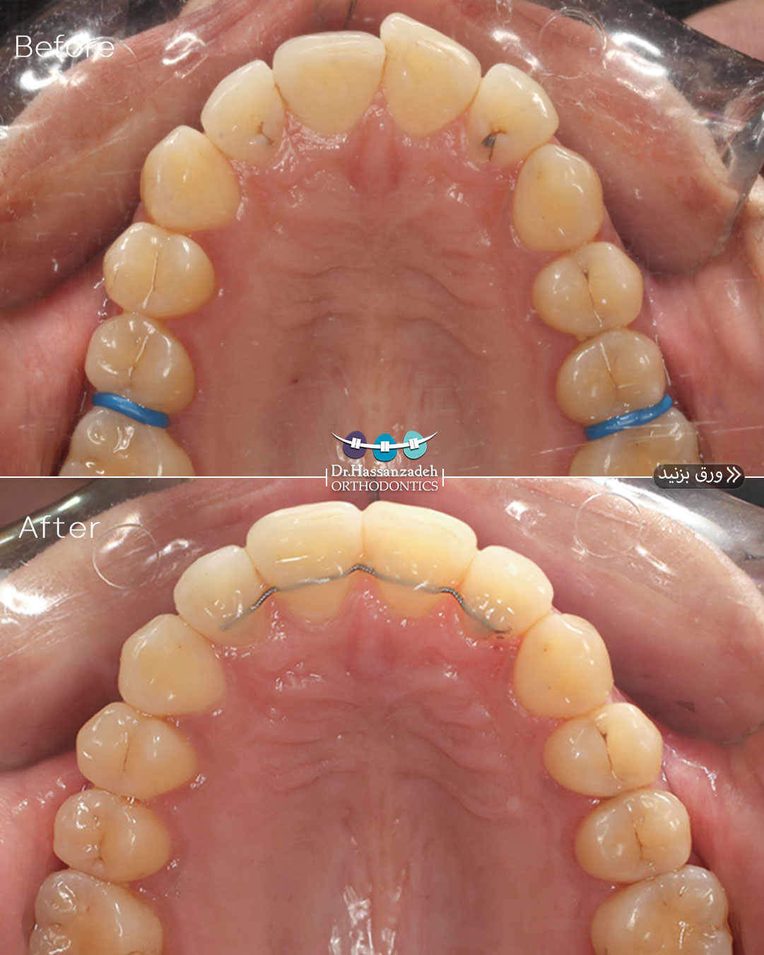 قبل و بعد از درمان اورتودنسی