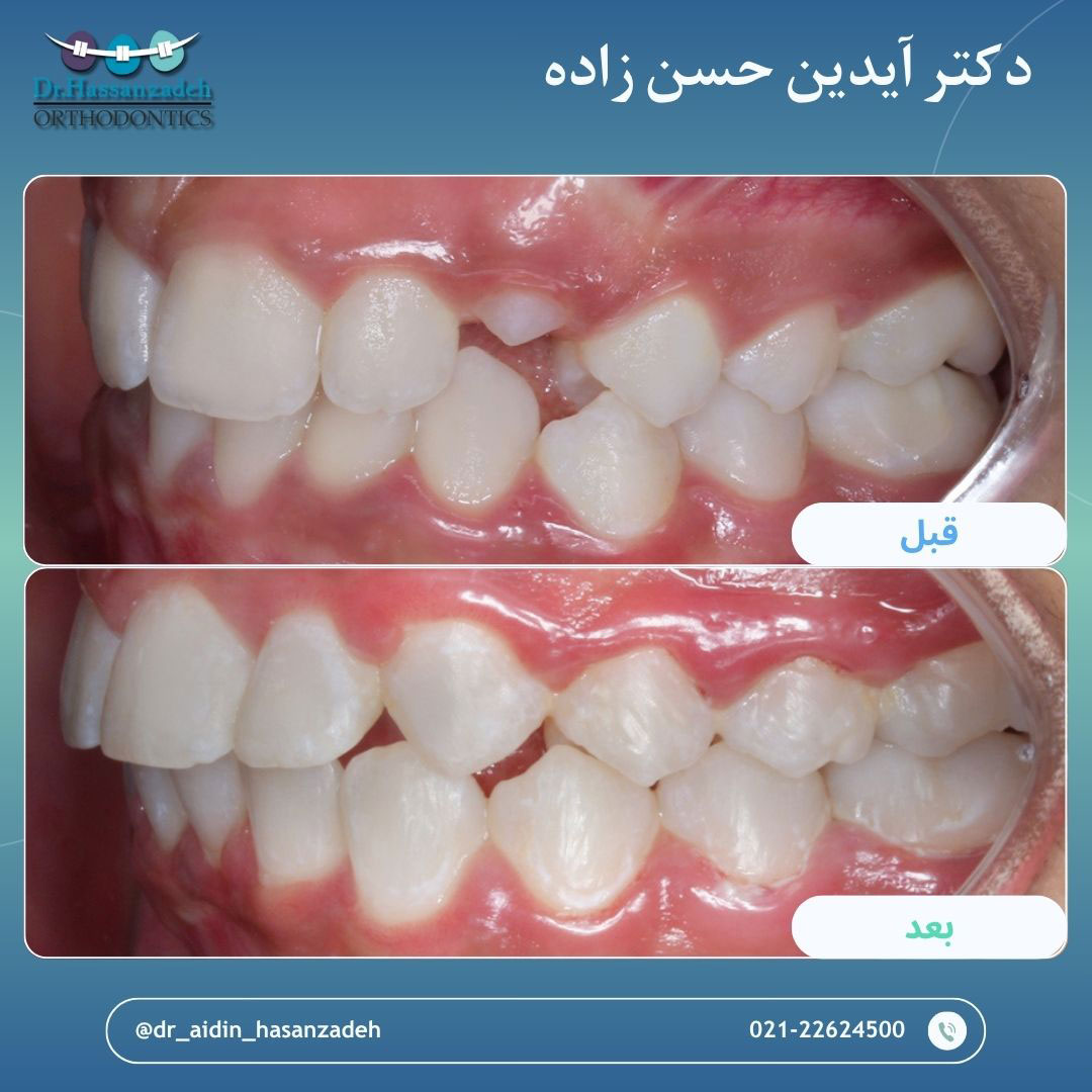 قبل و بعد از درمان اورتودنسی