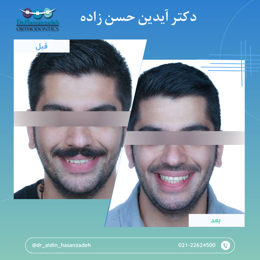 قبل و بعد از درمان