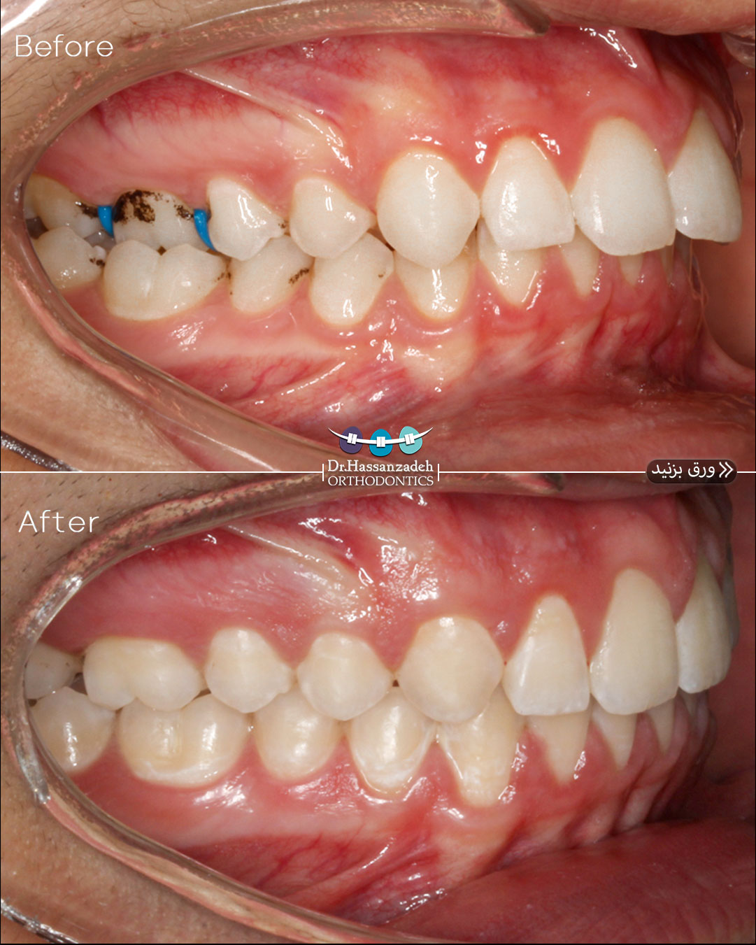 قبل و بعد از درمان اورتودنسی