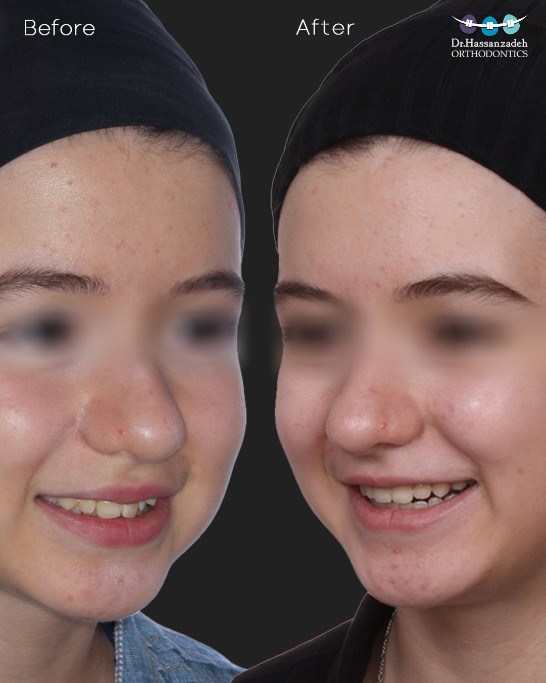 قبل و بعد از درمان اورتودنسی