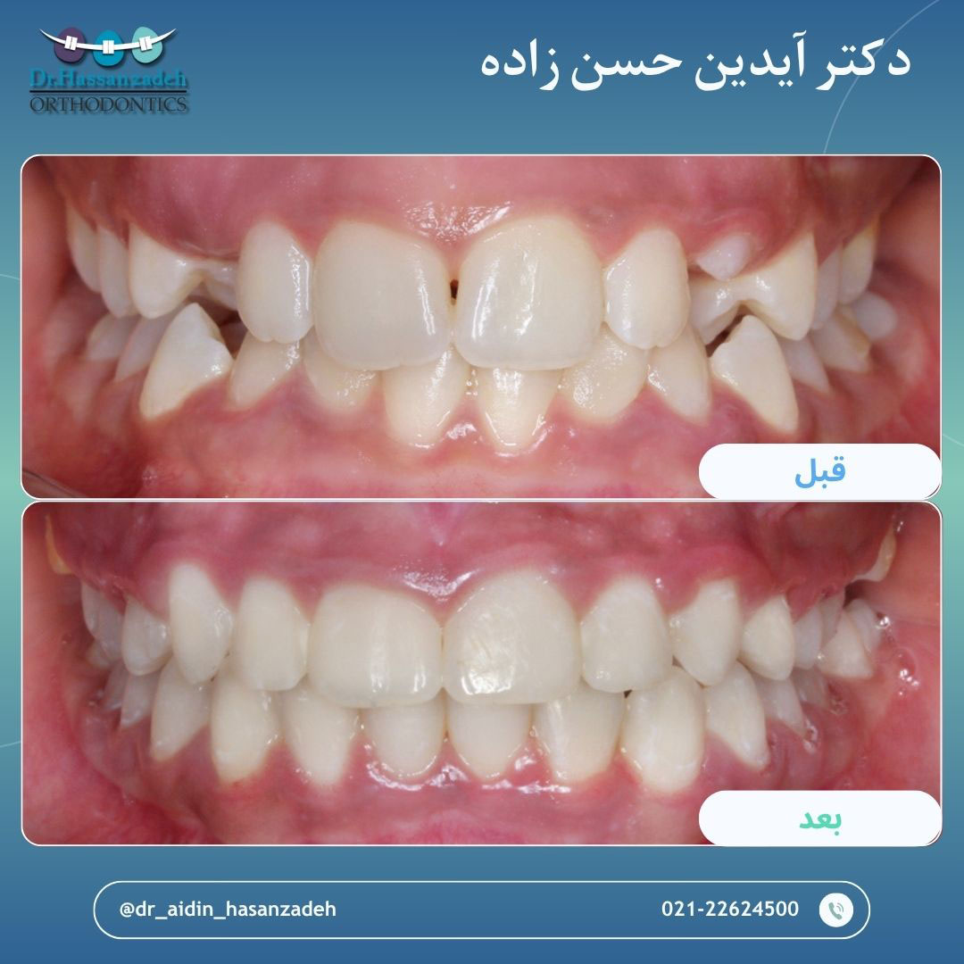قبل و بعد از درمان اورتودنسی
