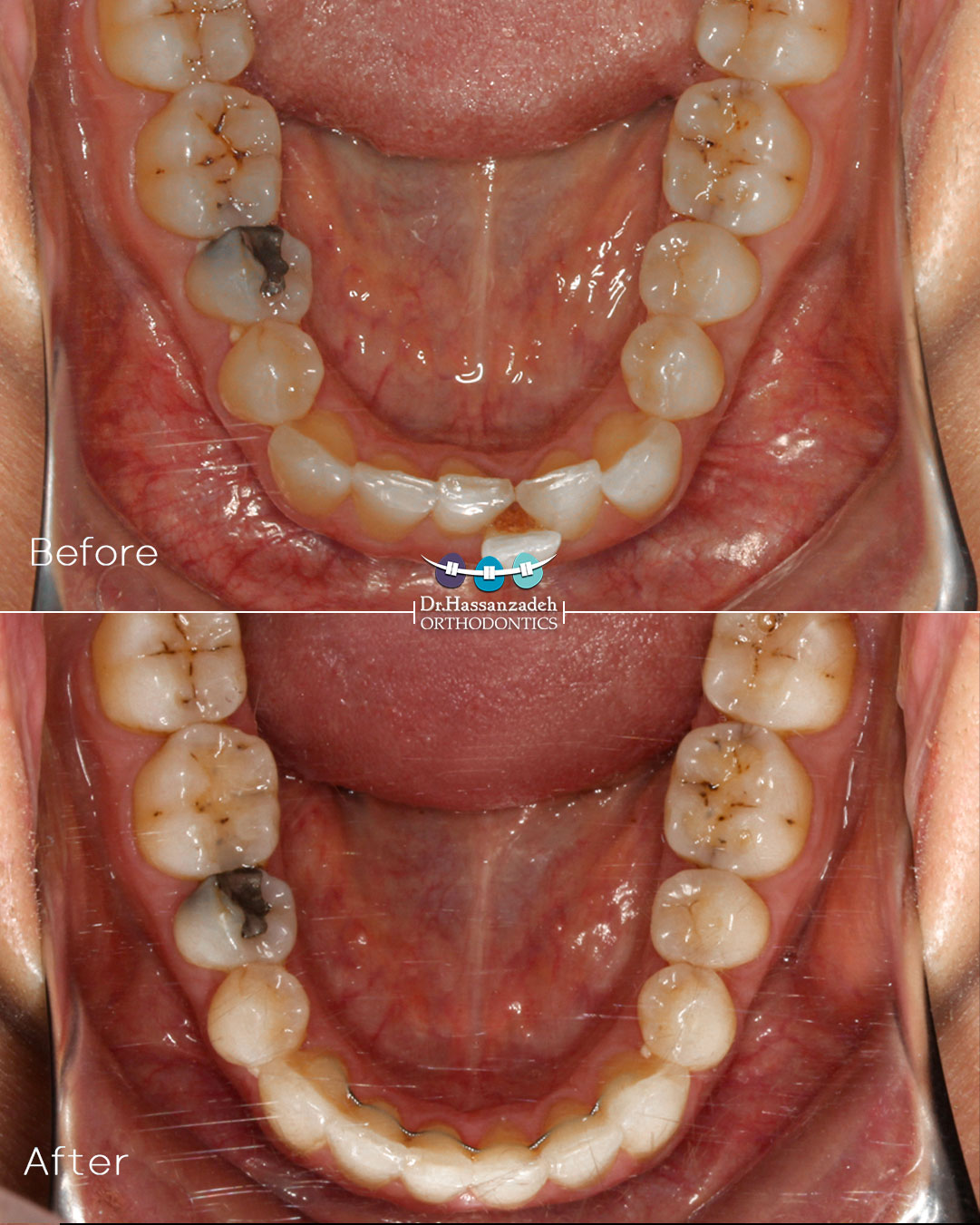 قبل و بعد از درمان اورتودنسی