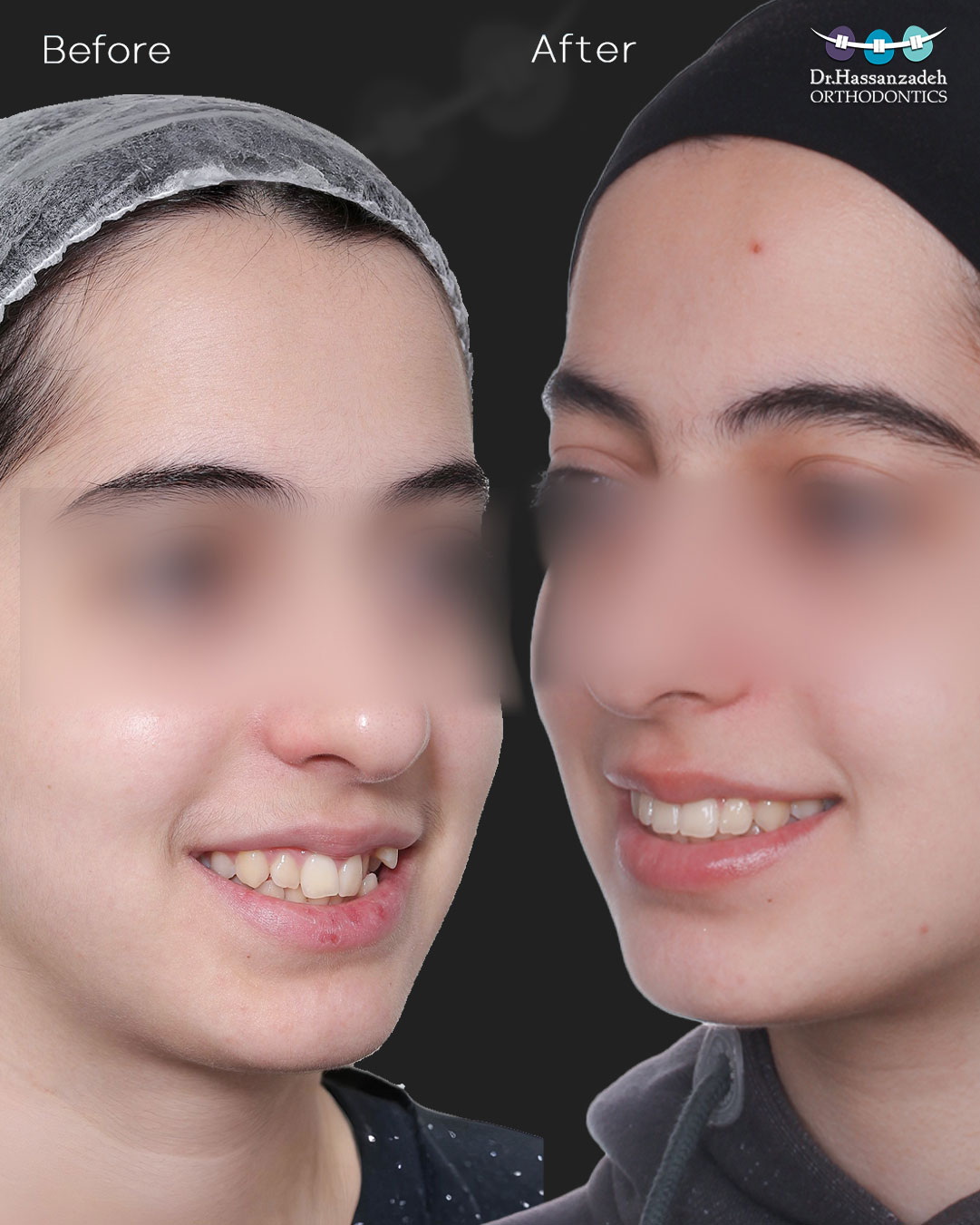 قبل و بعد از درمان اورتودنسی