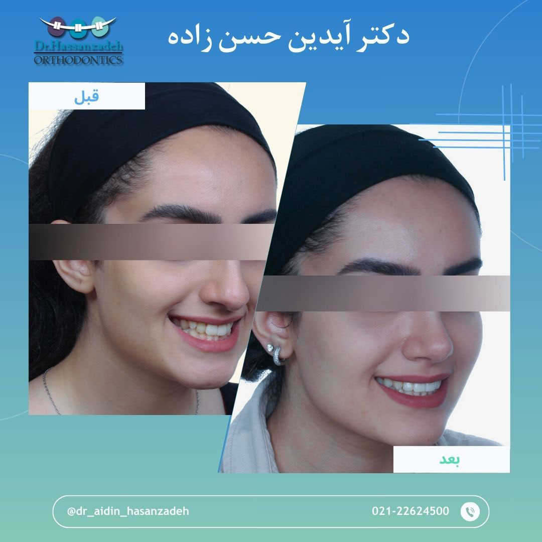 قبل و بعد از درمان اورتودنسی