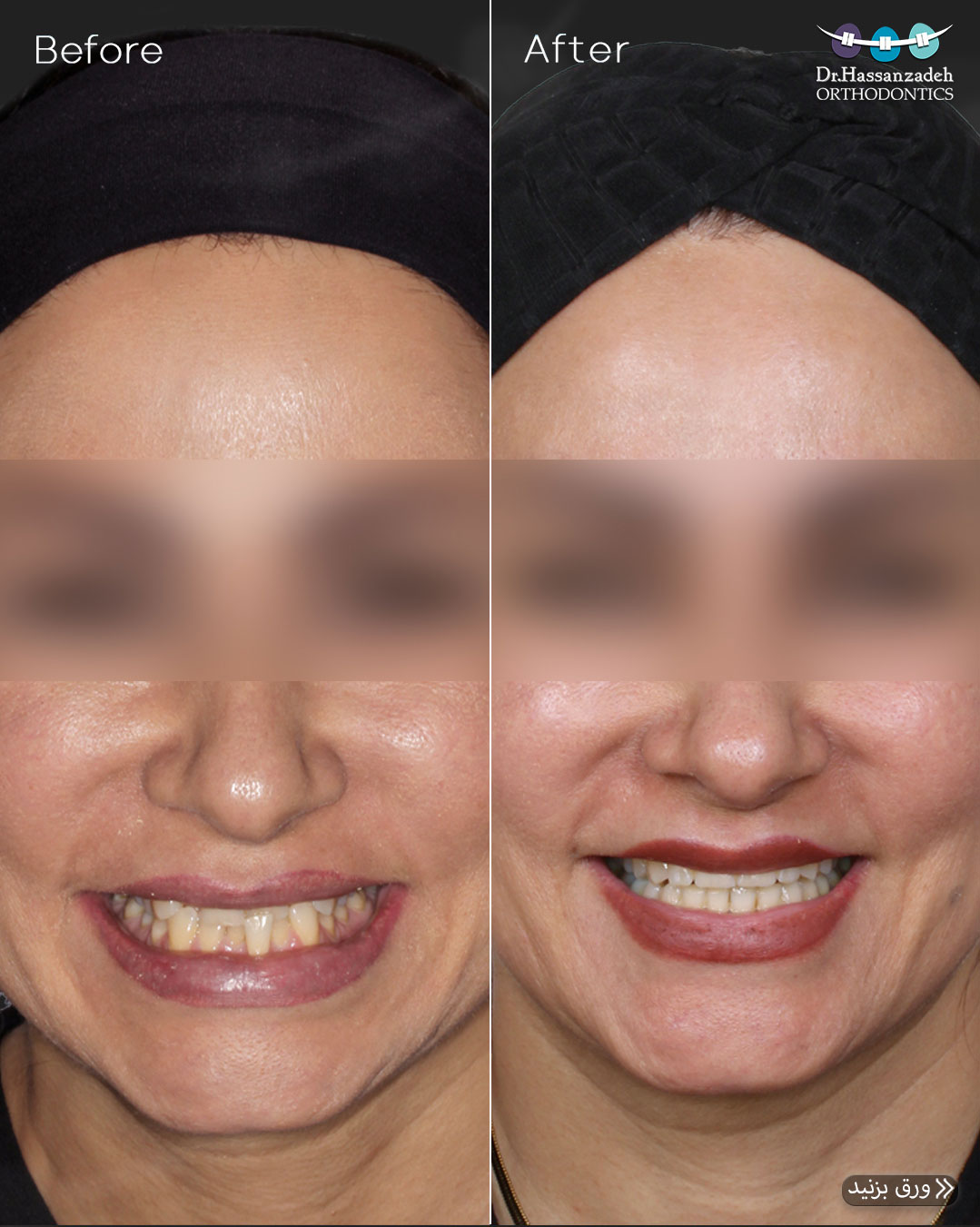 قبل و بعد از درمان