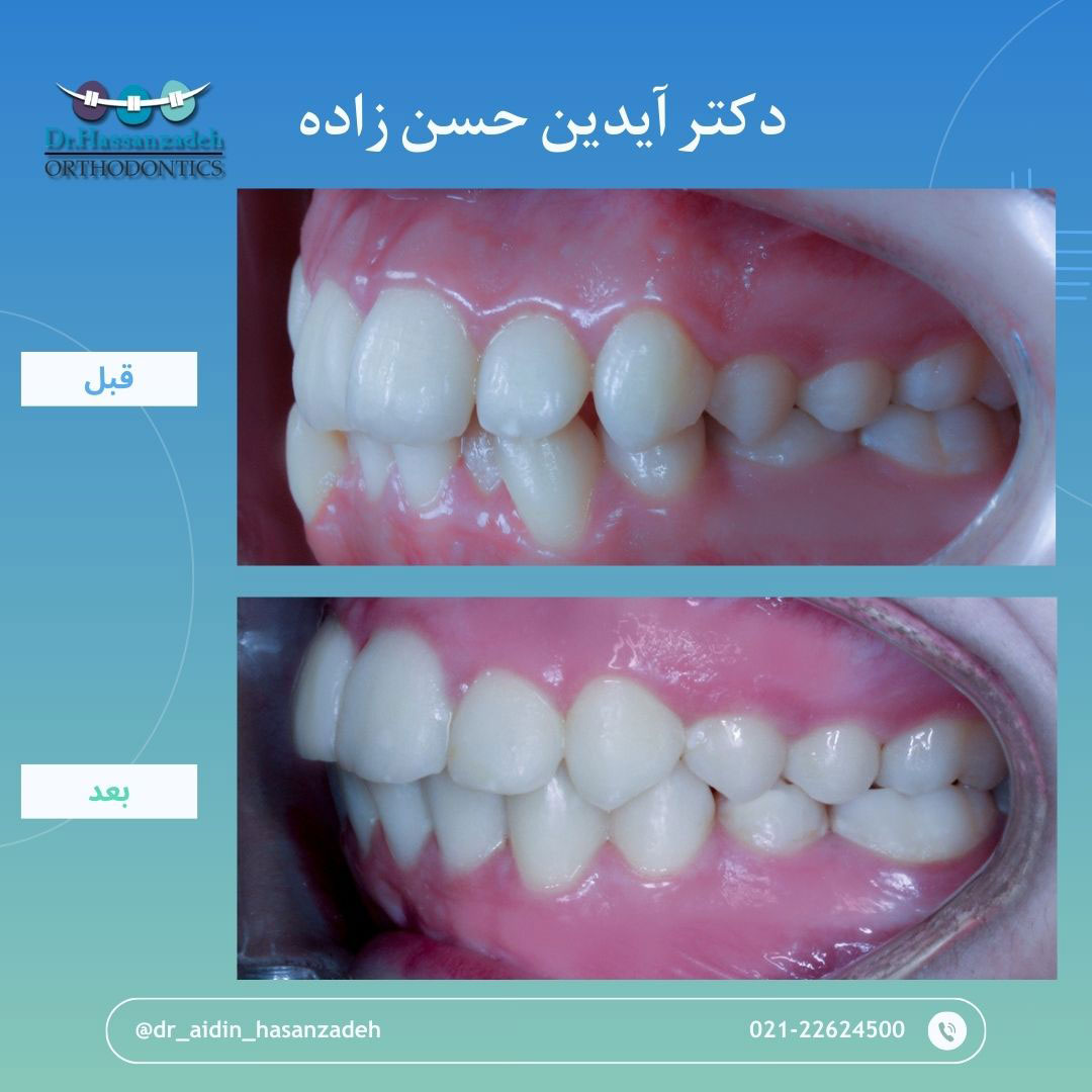 قبل و بعد از درمان اورتودنسی
