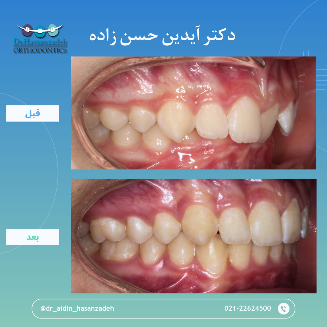 قبل و بعد از درمان اورتودنسی