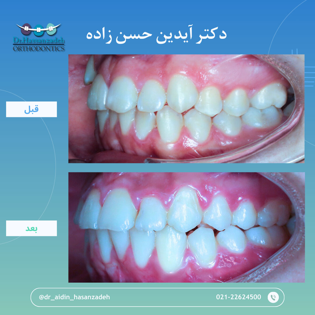 قبل و بعد از درمان اورتودنسی