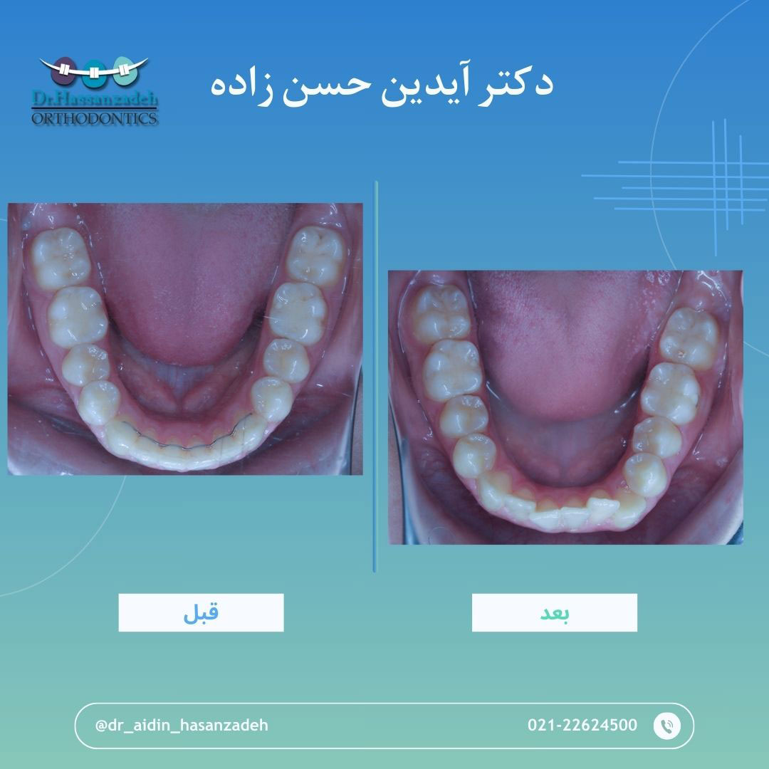 قبل و بعد از درمان اورتودنسی