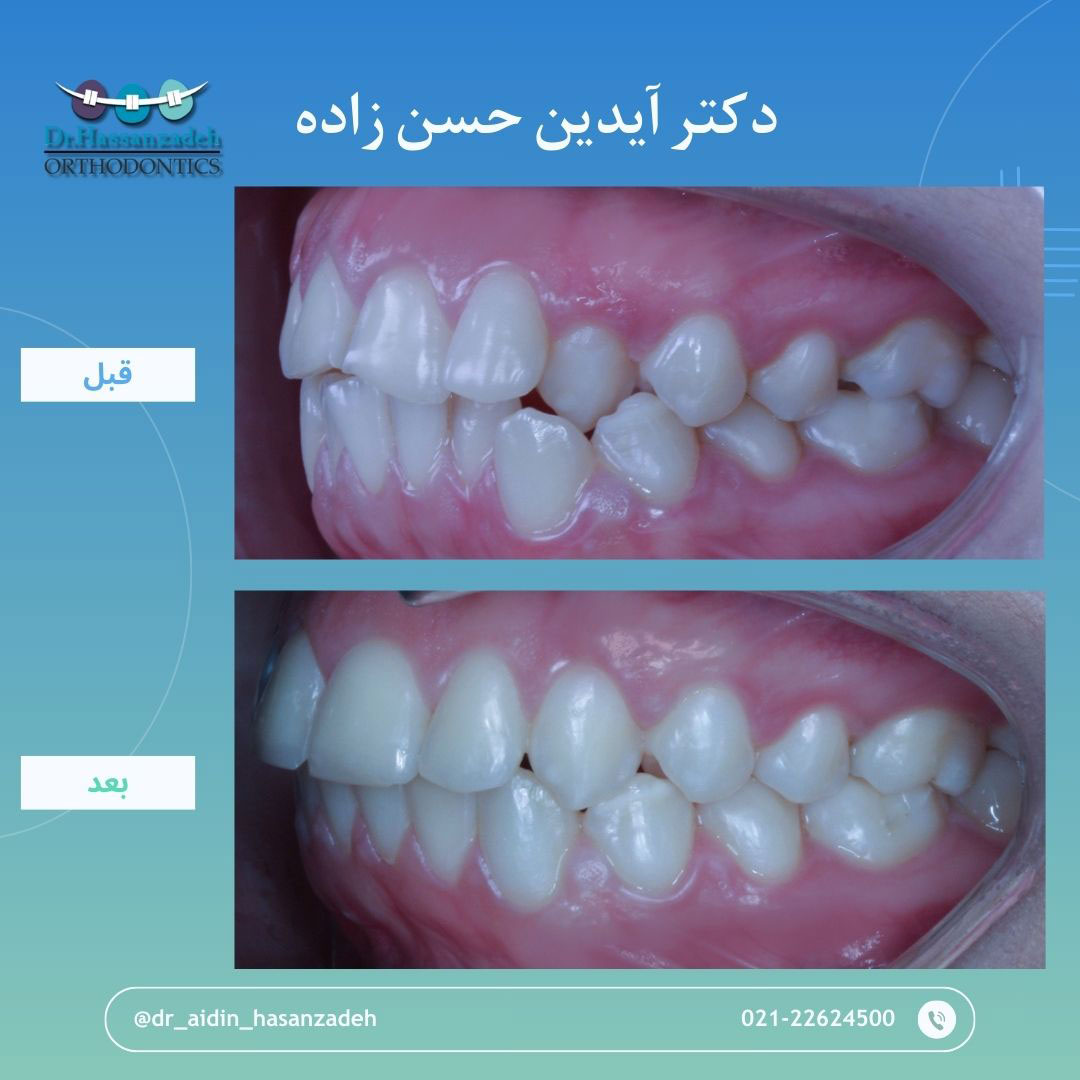 قبل و بعد از درمان اورتودنسی