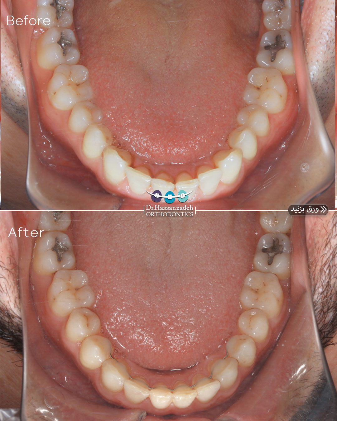 قبل و بعد از درمان اورتودنسی