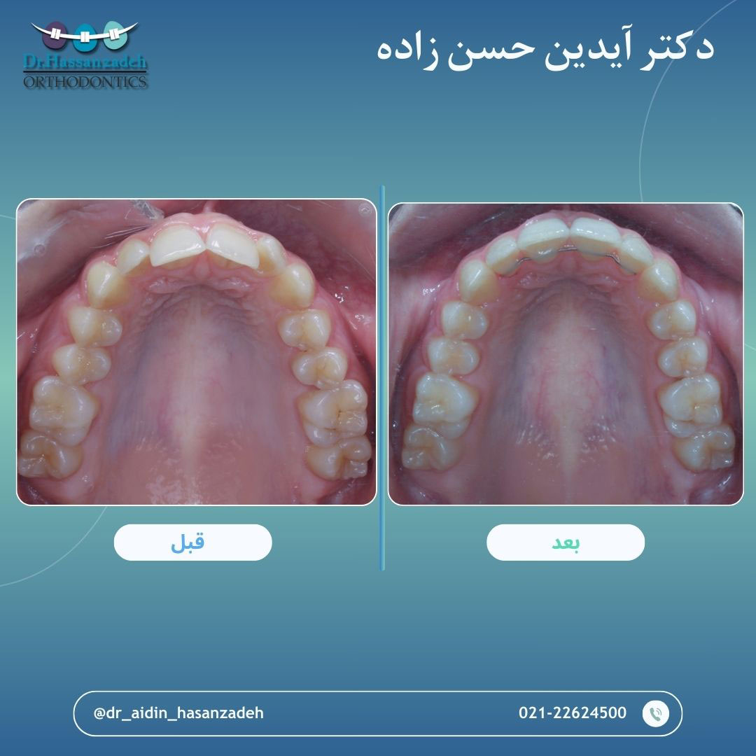 قبل و بعد از درمان اورتودنسی