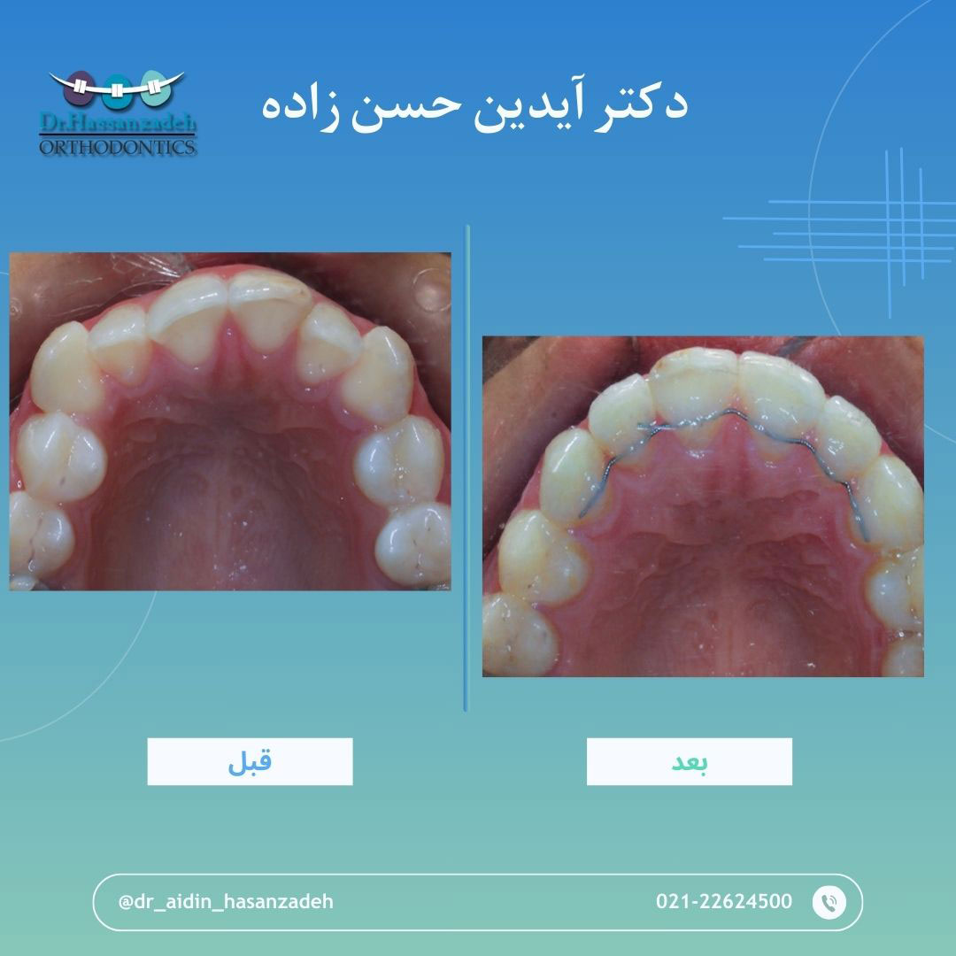 قبل و بعد از درمان اورتودنسی