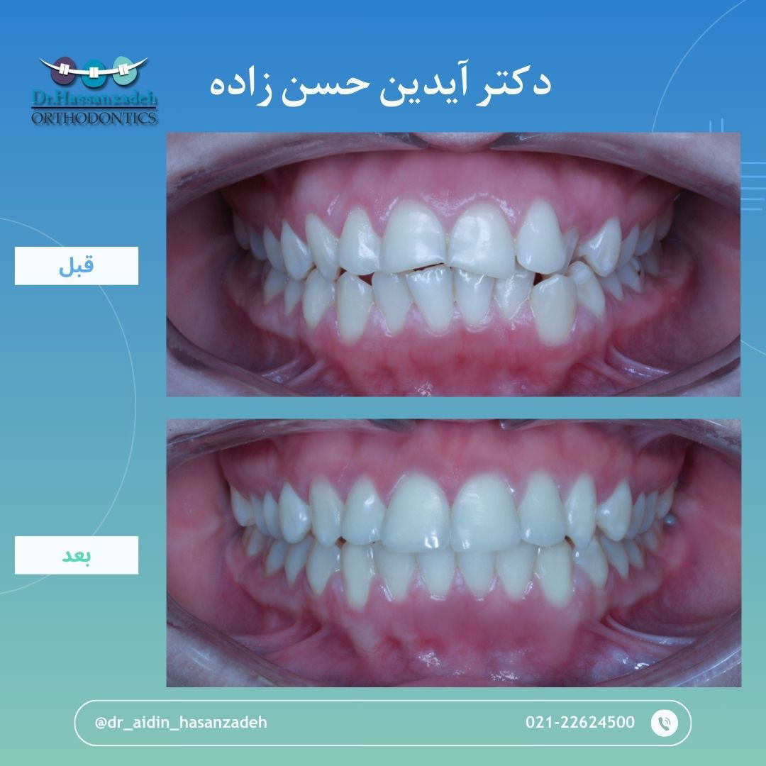 قبل و بعد از درمان اورتودنسی