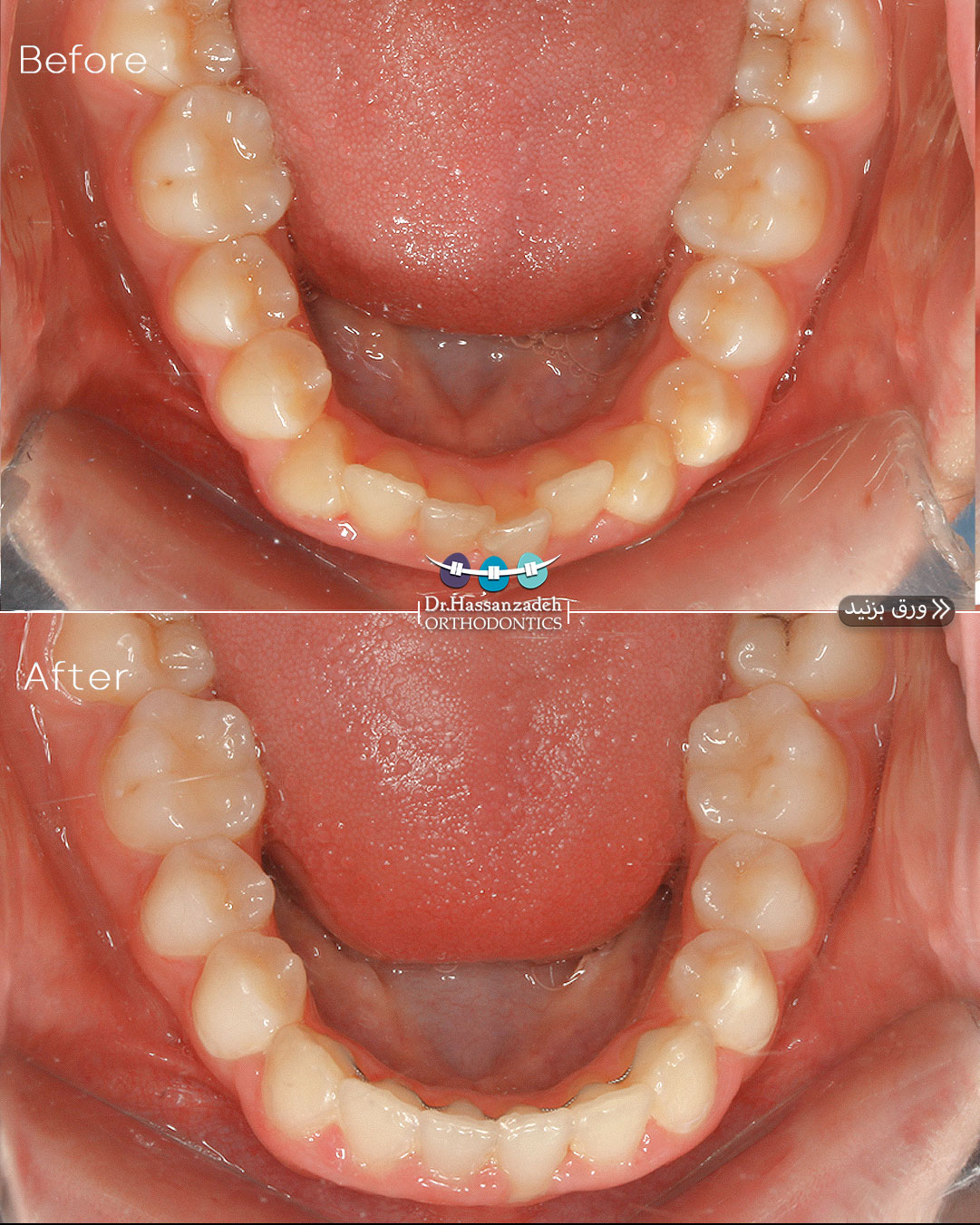 قبل و بعد از درمان اورتودنسی