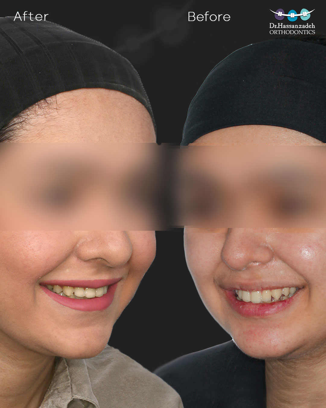 قبل و بعد از درمان اورتودنسی