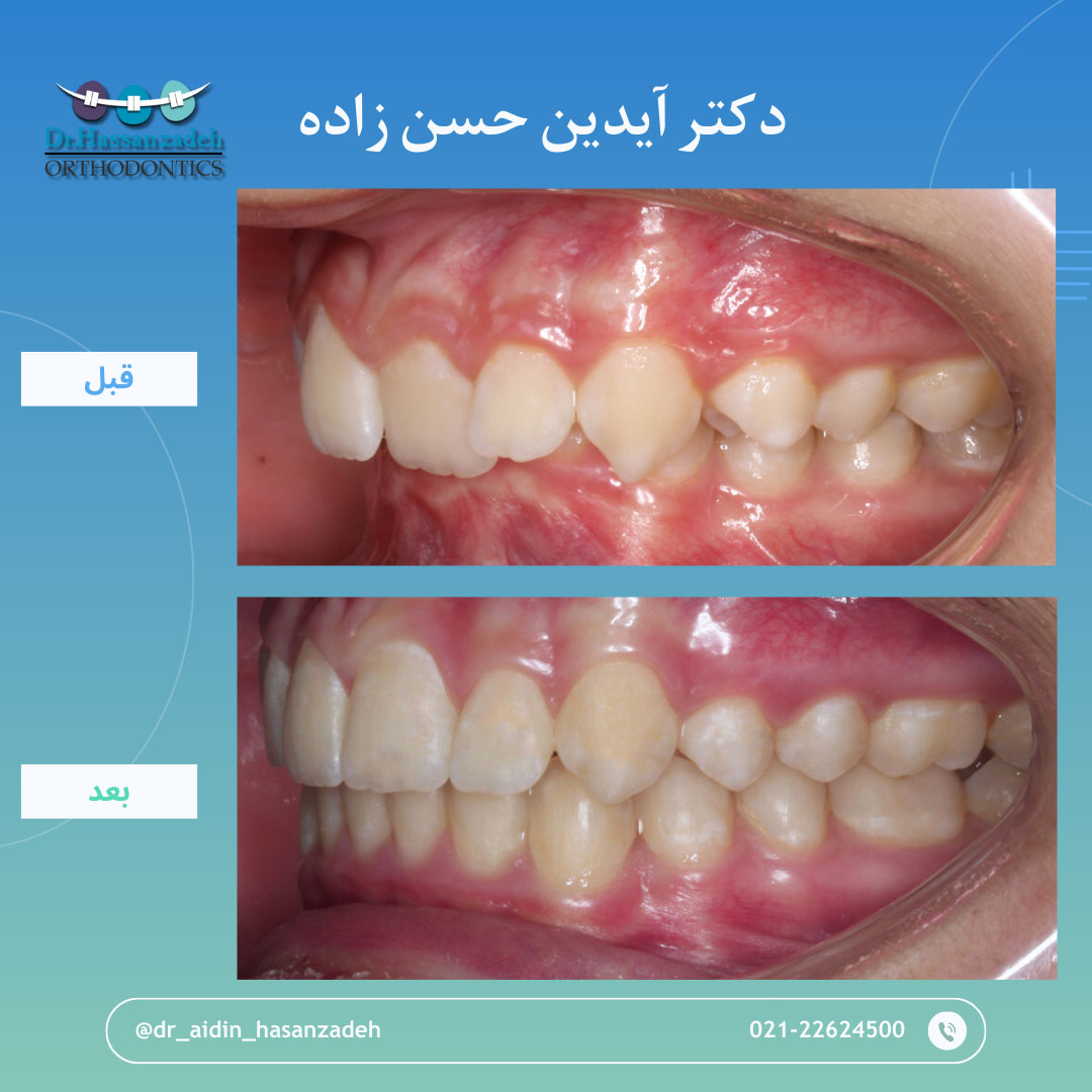 قبل و بعد از درمان اورتودنسی