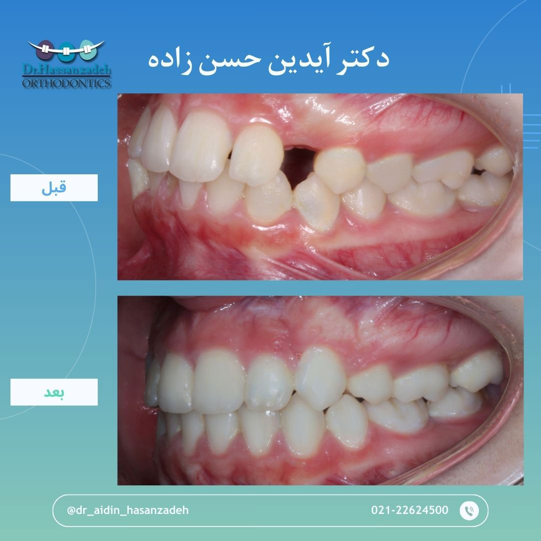 قبل و بعد از درمان اورتودنسی