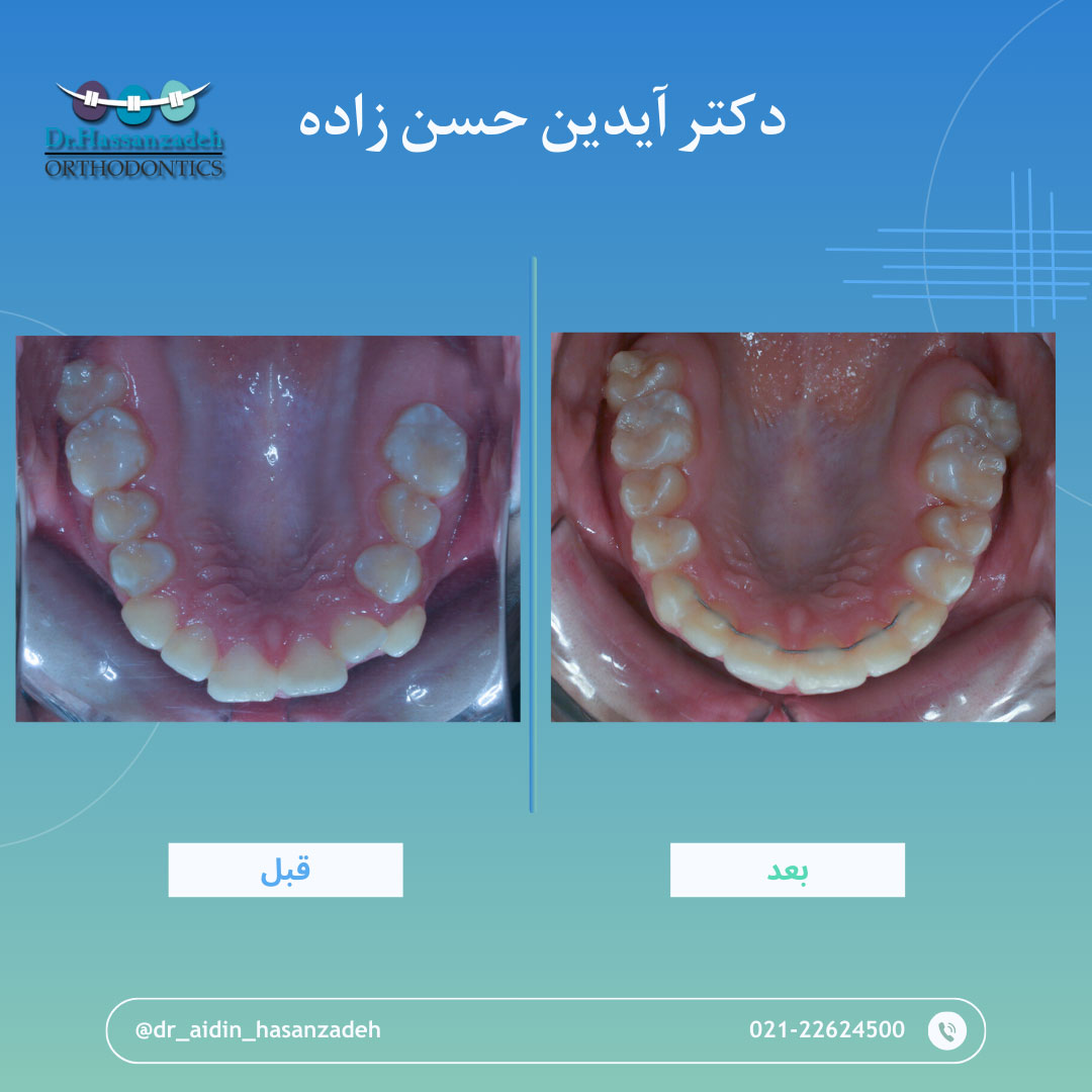قبل و بعد از درمان اورتودنسی