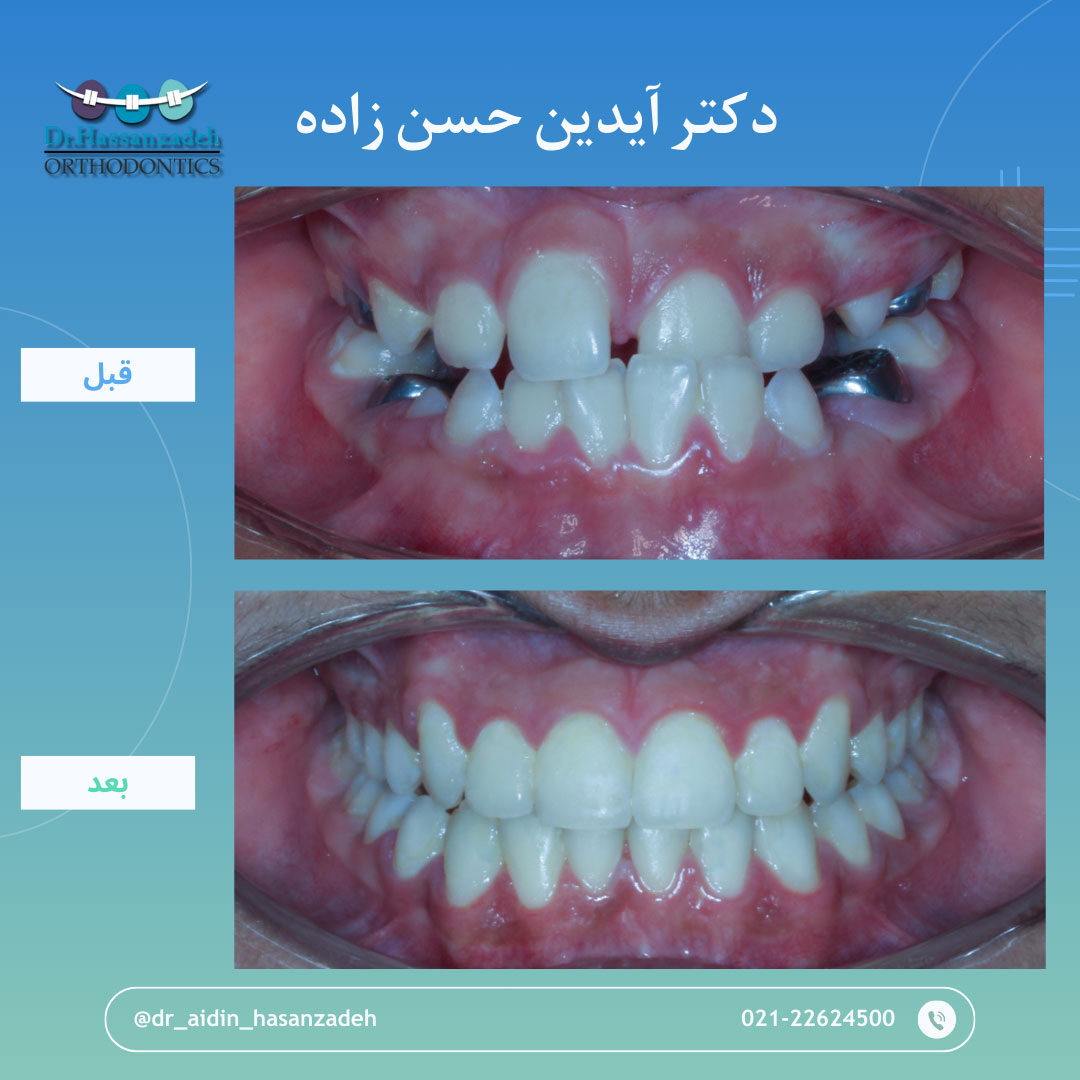 قبل و بعد از درمان اورتودنسی