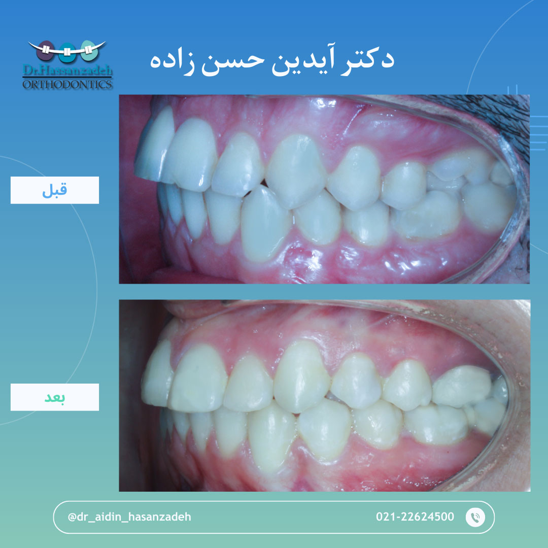 قبل و بعد از درمان اورتودنسی