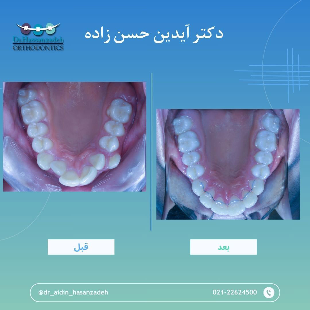 قبل و بعد از درمان اورتودنسی