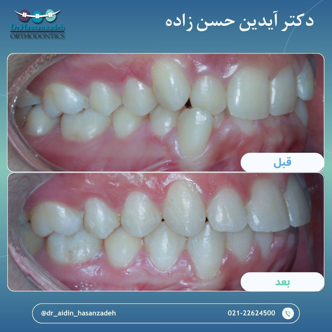 قبل و بعد از درمان اورتودنسی