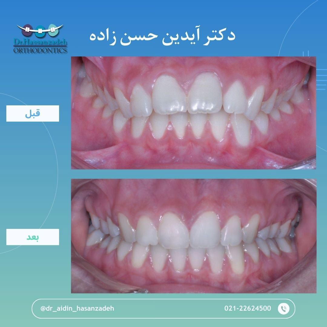 قبل و بعد از درمان اورتودنسی