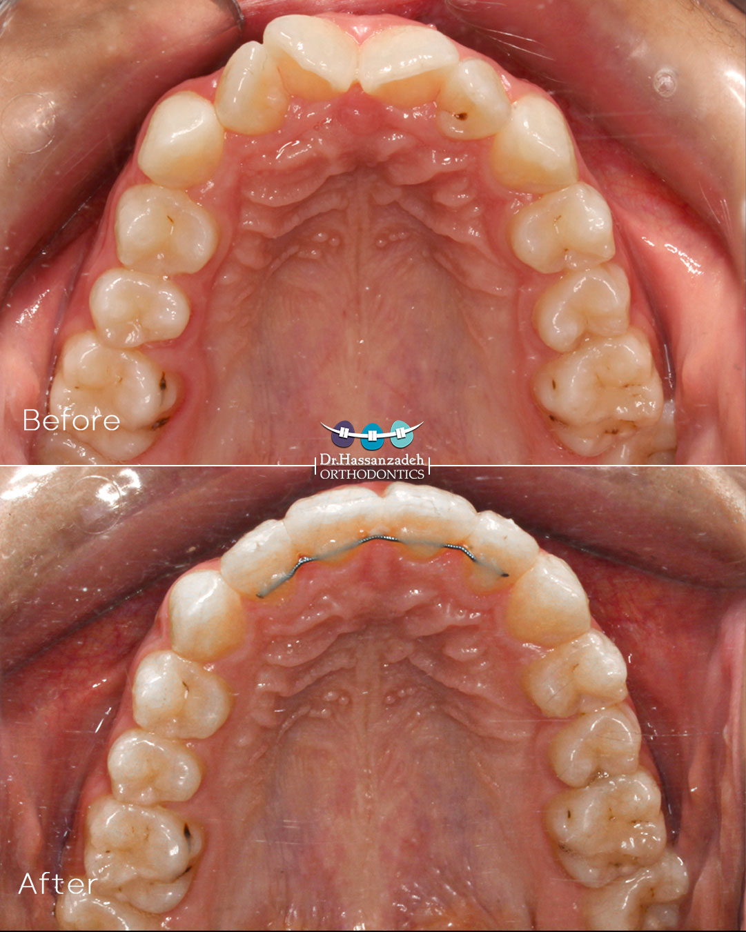 قبل و بعد از درمان اورتودنسی
