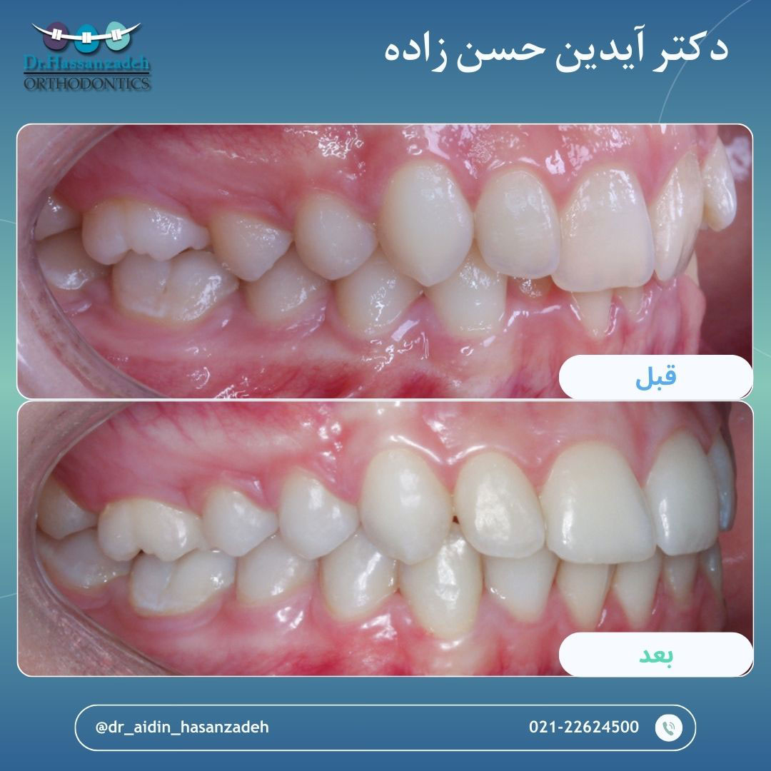 قبل و بعد از درمان اورتودنسی