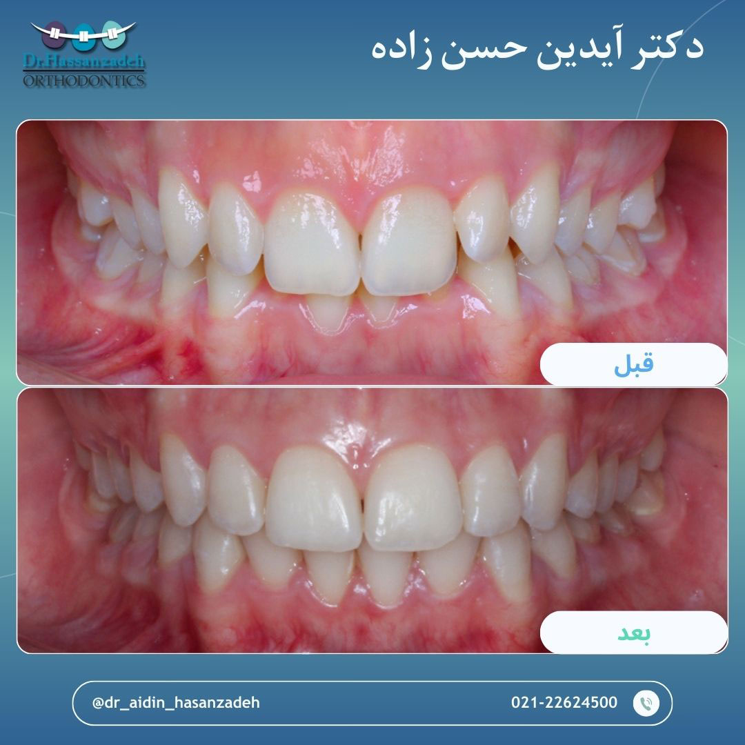 قبل و بعد از درمان اورتودنسی