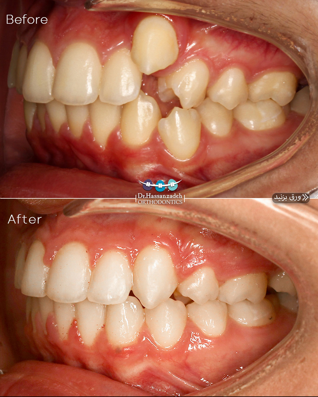 قبل و بعد از درمان اورتودنسی