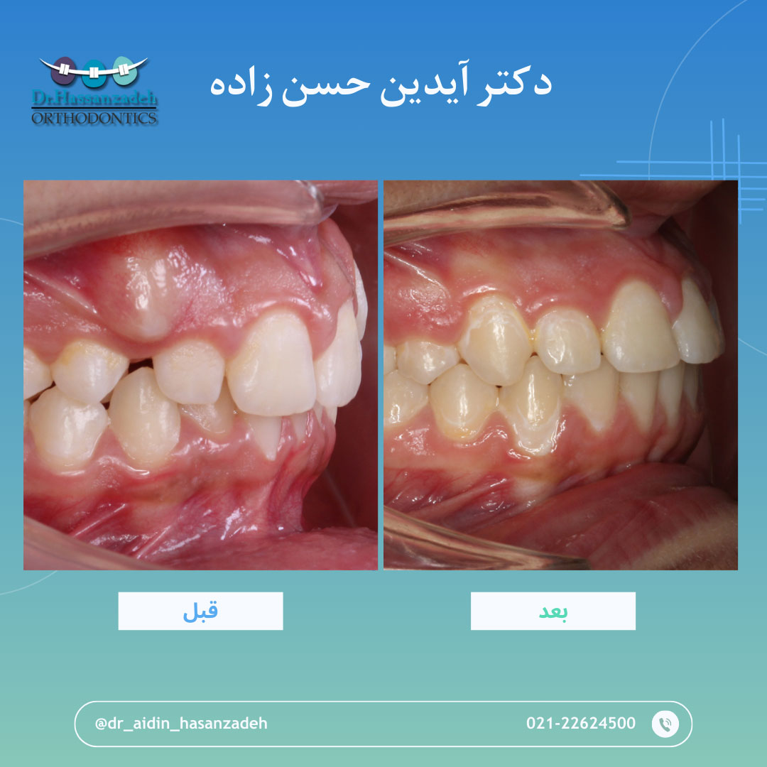 قبل و بعد از درمان اورتودنسی