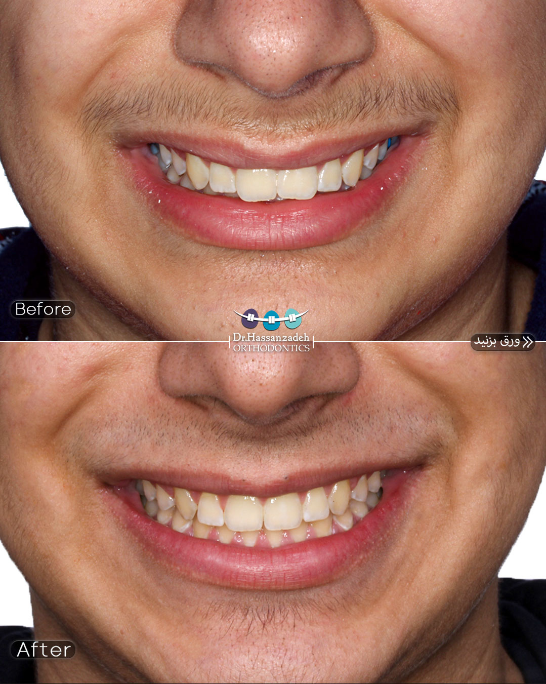 قبل و بعد از درمان اورتودنسی