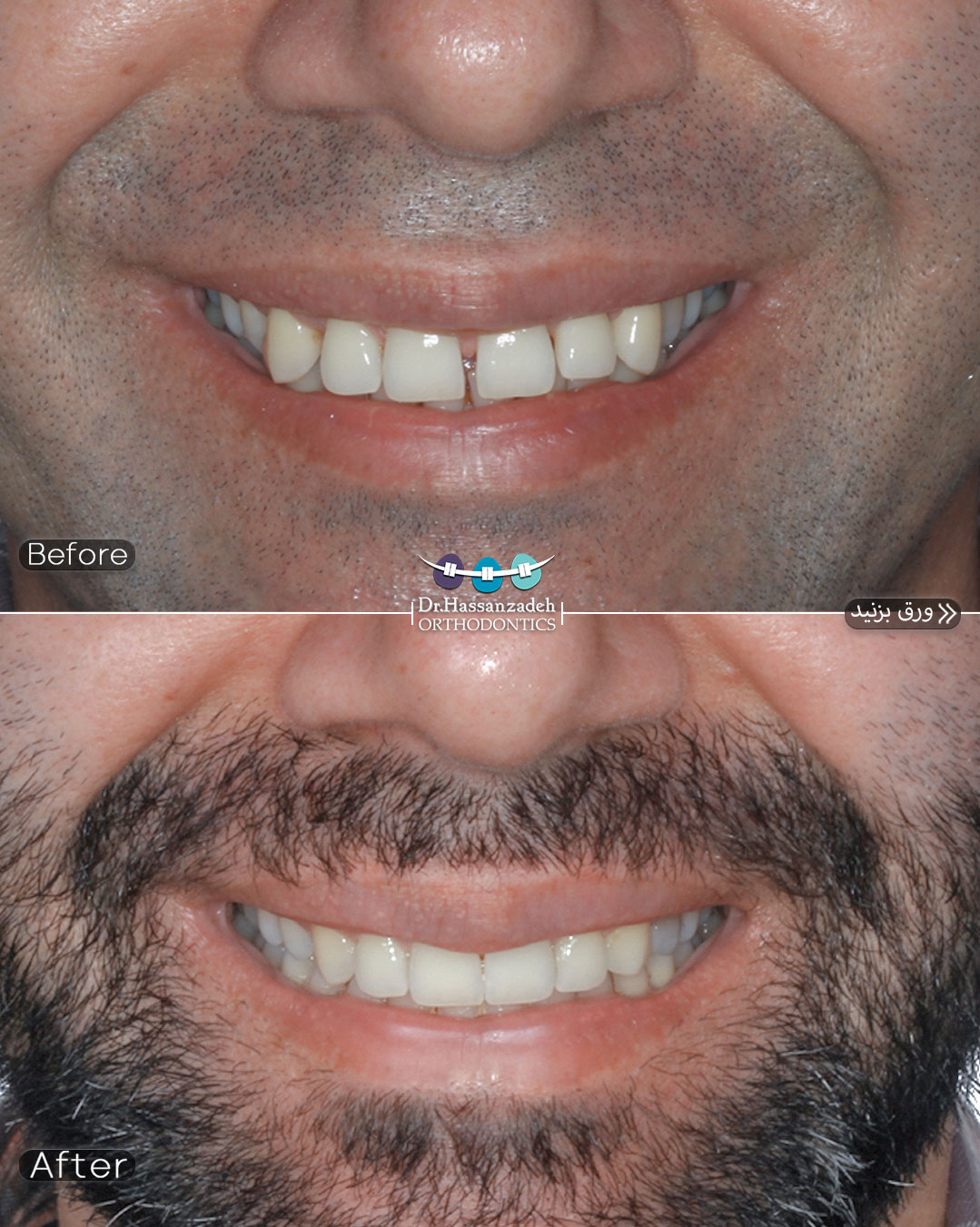 قبل و بعد از درمان اورتودنسی
