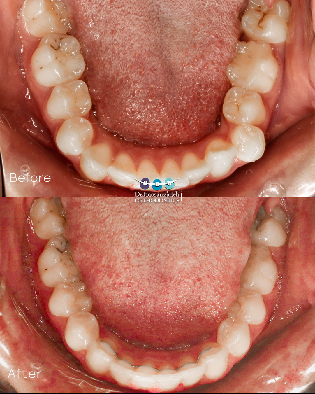 قبل و بعد از درمان اورتودنسی