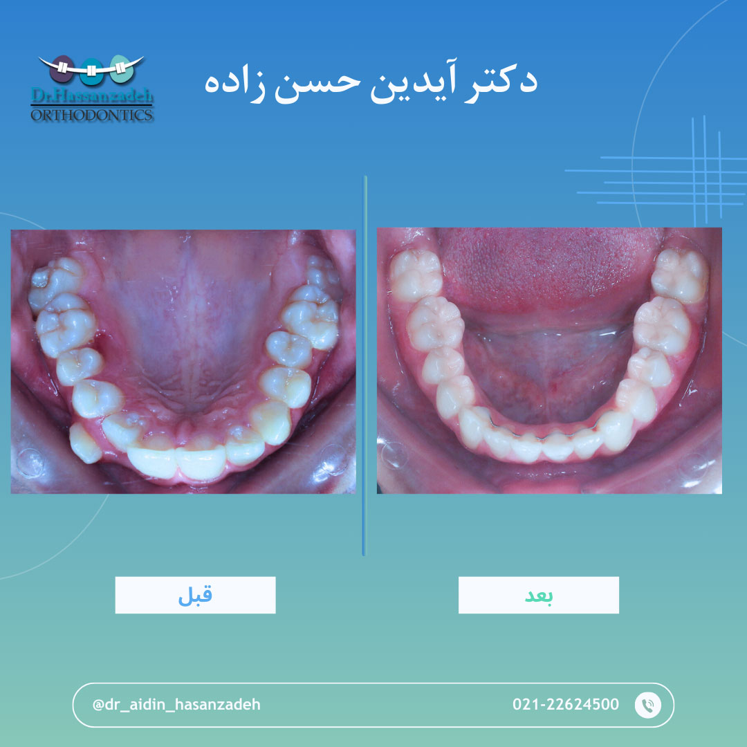 قبل و بعد از درمان اورتودنسی