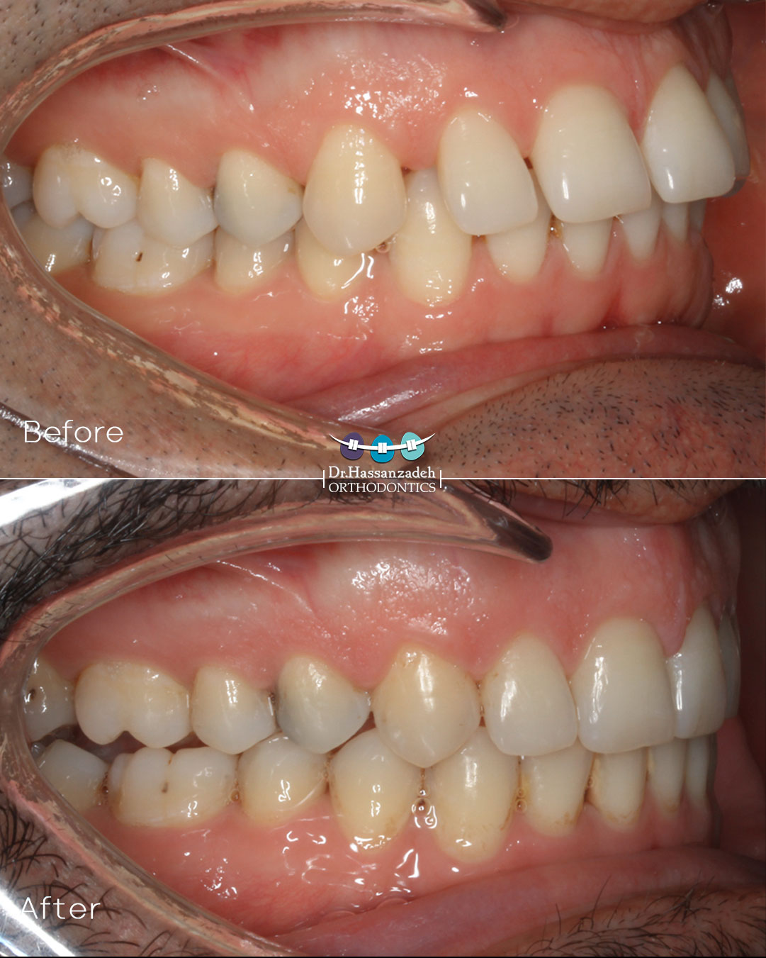 قبل و بعد از درمان اورتودنسی