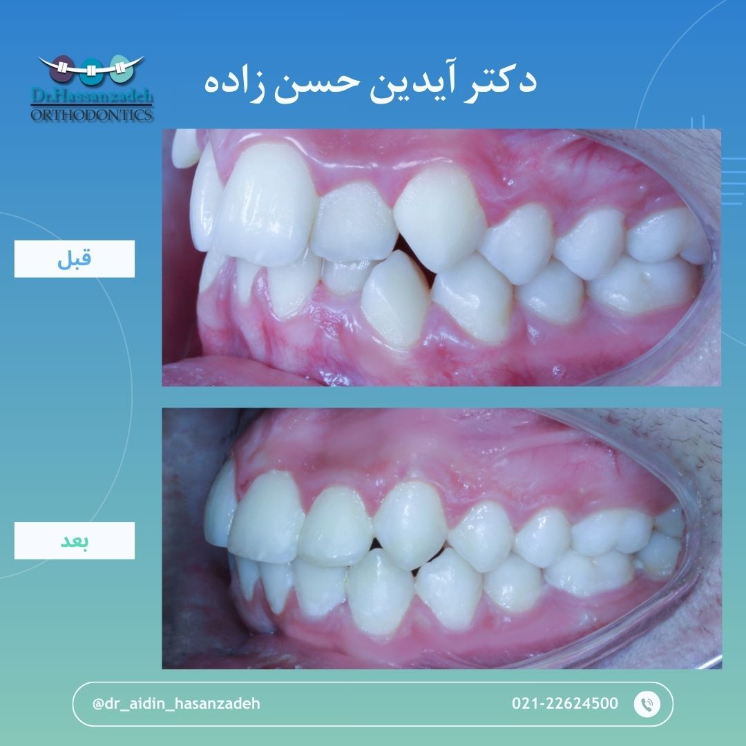 قبل و بعد از درمان اورتودنسی