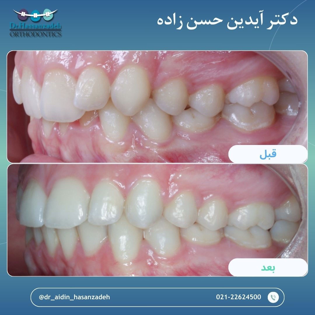 قبل و بعد از درمان اورتودنسی