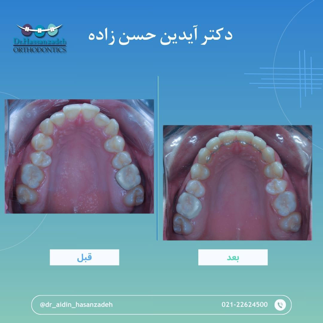 قبل و بعد از درمان اورتودنسی