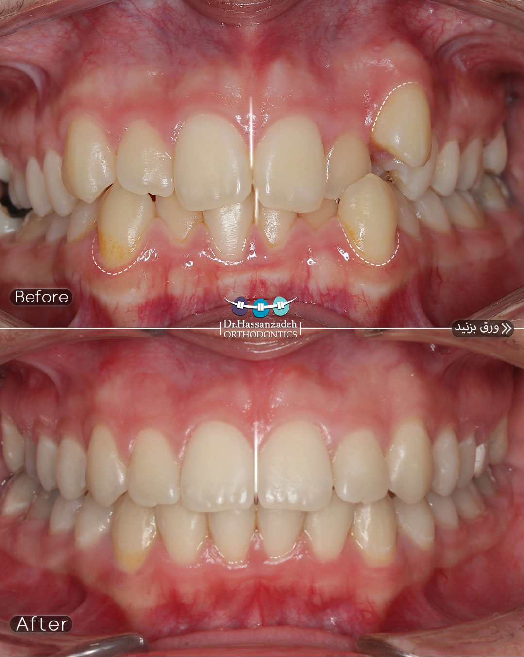 قبل و بعد از درمان اورتودنسی