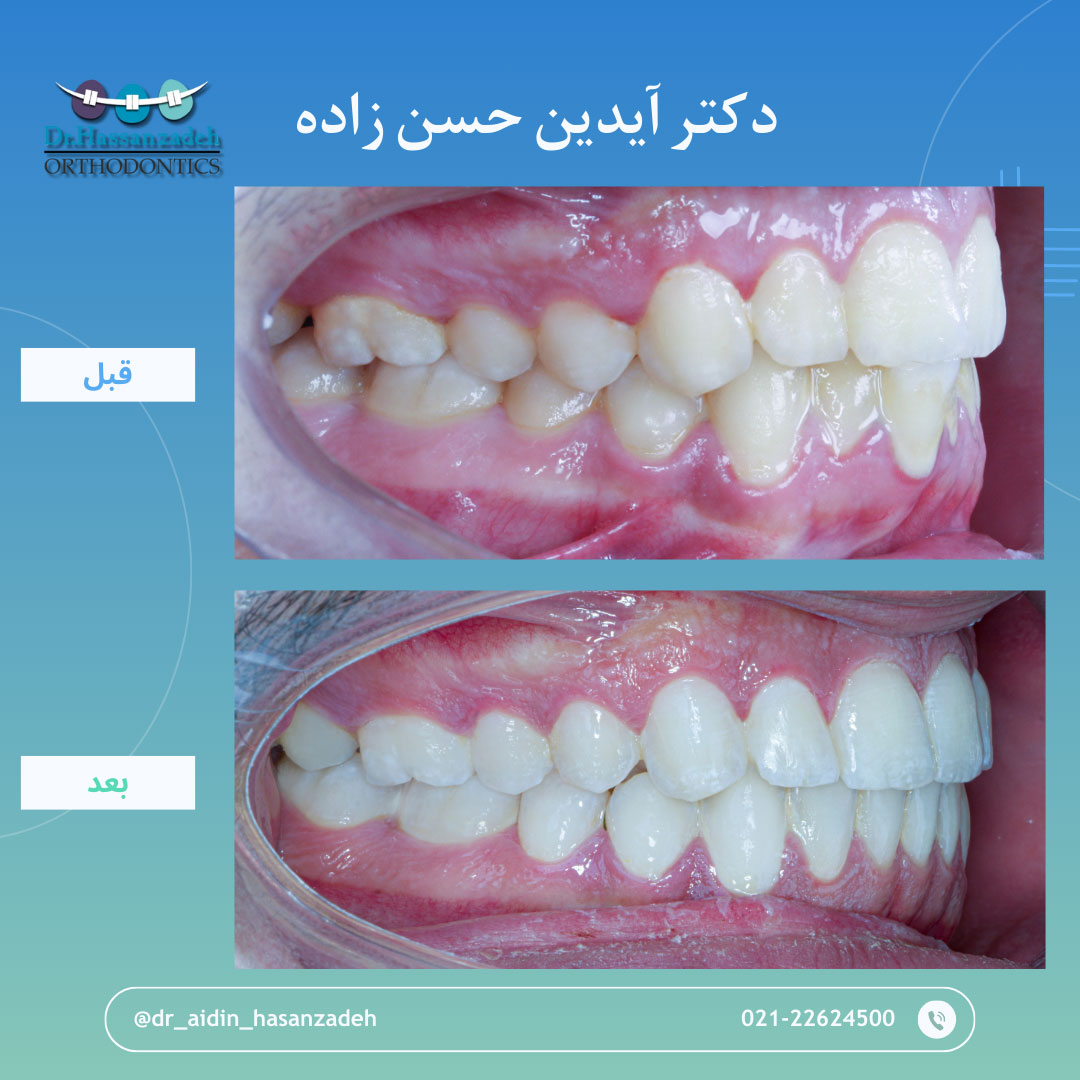 قبل و بعد از درمان اورتودنسی